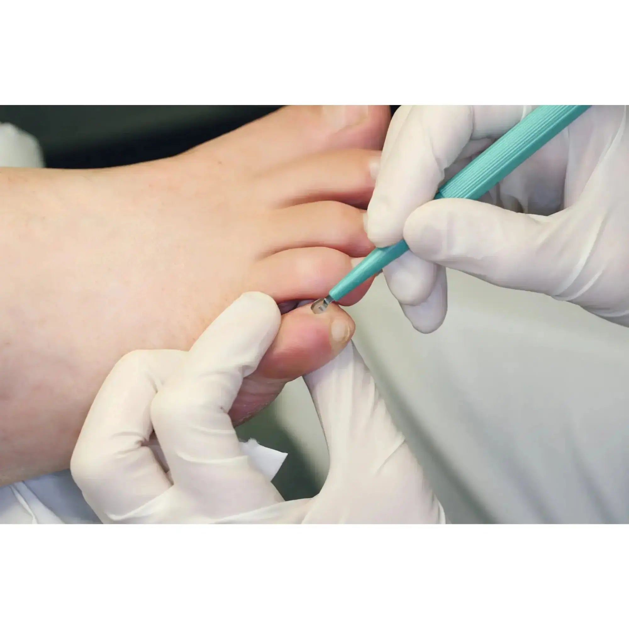 Curette per pelle - Lunghezza: 15 cm - Ruck Ruck 