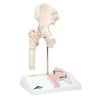 Fractura de fémur y desgaste de la articulación de la cadera - Anatomía y patología