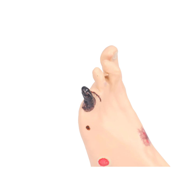 Foot model with wounds - Anatomy and pathology My Podiatry 